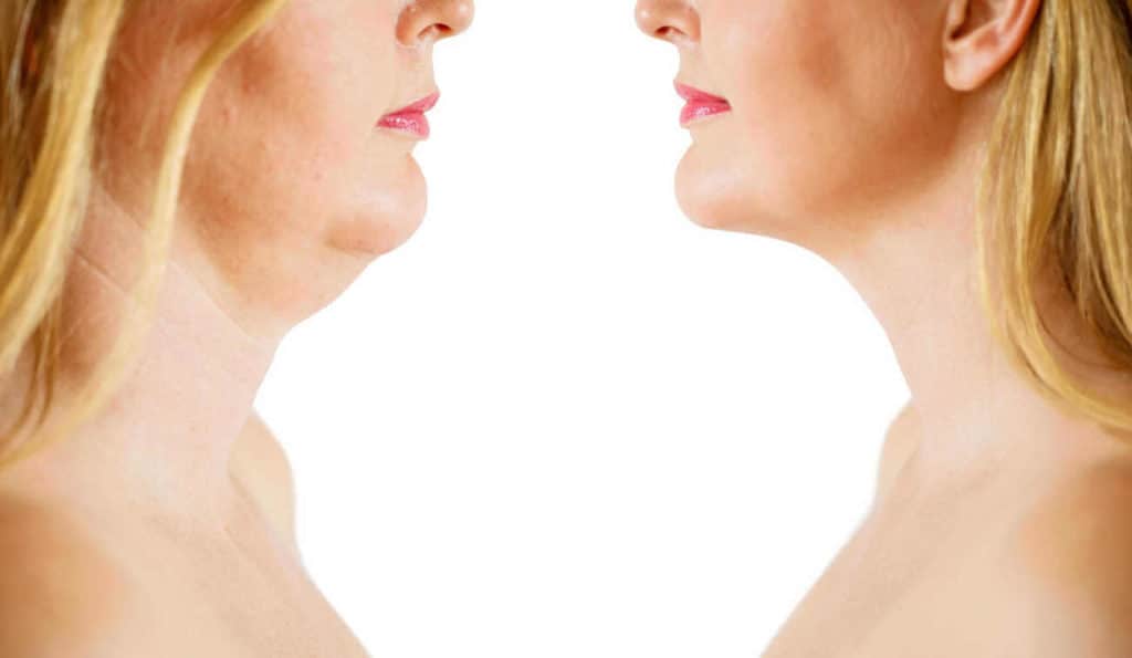Double Chin treatment Birmingham before and after results