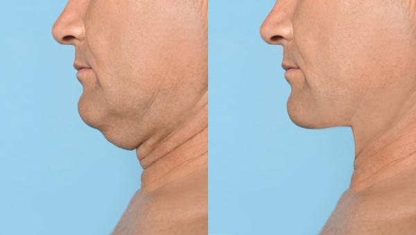 Which Non-Surgical Treatments Work Best for Jowls and Loose Skin Birmingham?