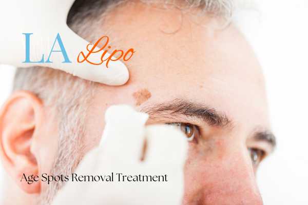 What Are the Most Effective Treatments for Age Spots Birmingham?