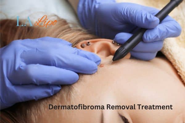 Dermatofibroma Removal Treatment Birmingham