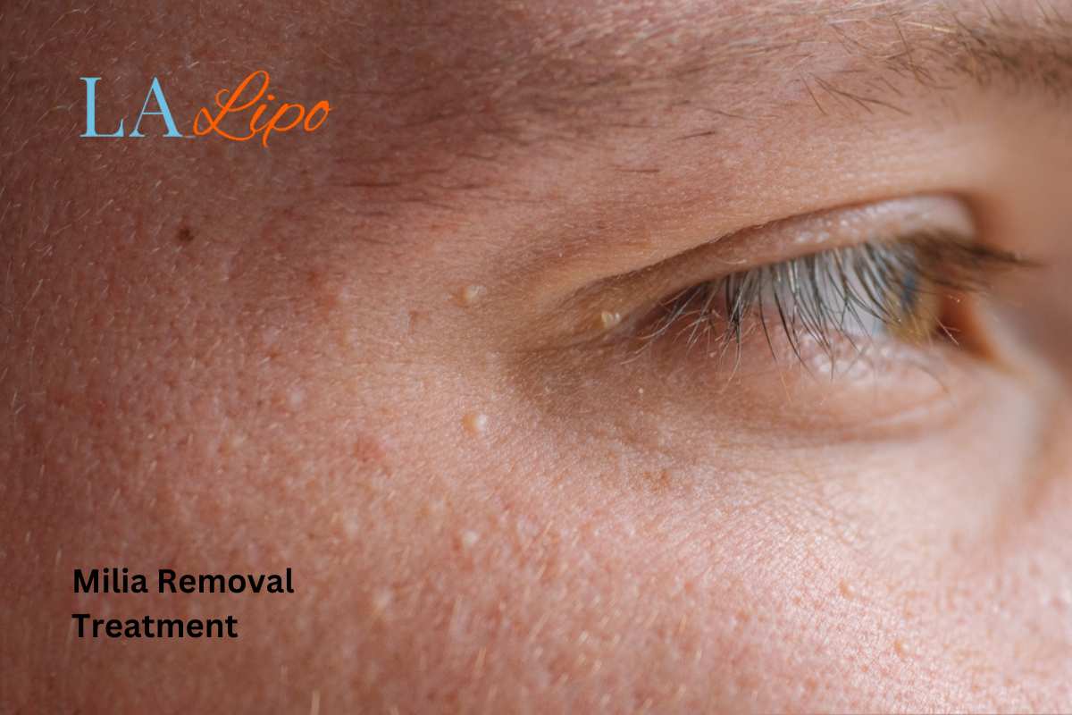 Cryopen Milia Removal: Is It the Easiest and Safest Option Birmingham?