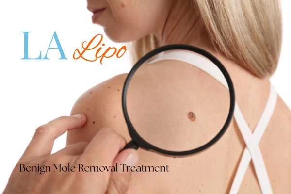 Why getting moles removed Birmingham can boost your confidence!