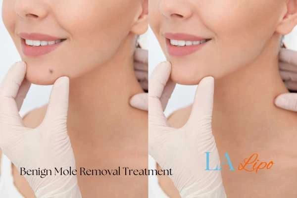 Woman's before and after results of being moles removal treatment Birmingham