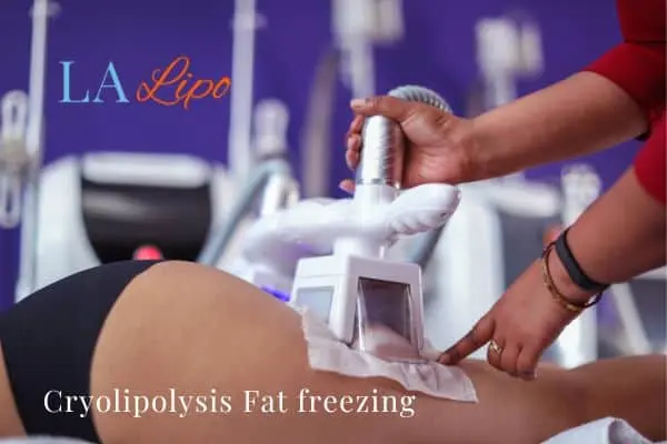 women getting fat freezing Birmingham
