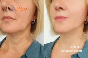hi-fu for wrinkles Birmingham before and after results