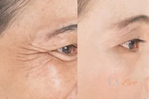 Before and after results of woman - HI-fu wrinkles reduction treatment Birmingham