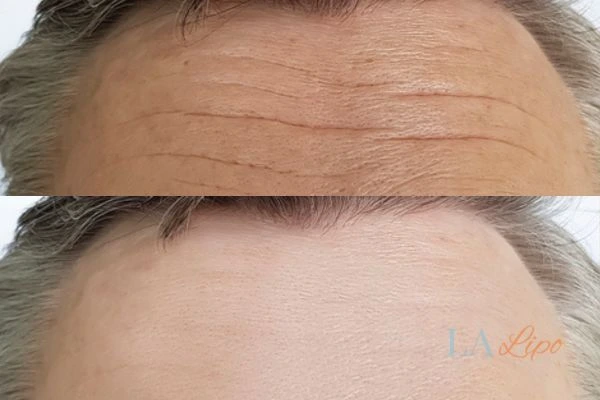 results of HIFU Birmingham on mans forehead to help reduce lines and wrinkles