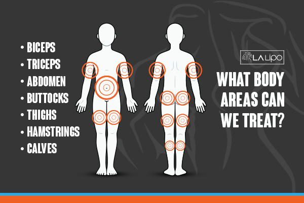 Graphic to show areas you can have LA-EMS Body Sculpting Birmingham treatment.