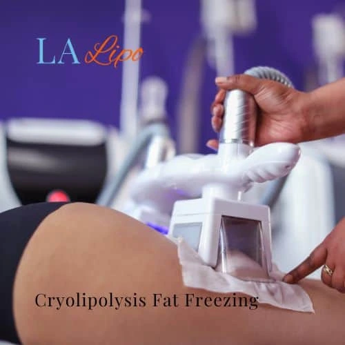fat freezing - Cryolipolysis Birmingham
