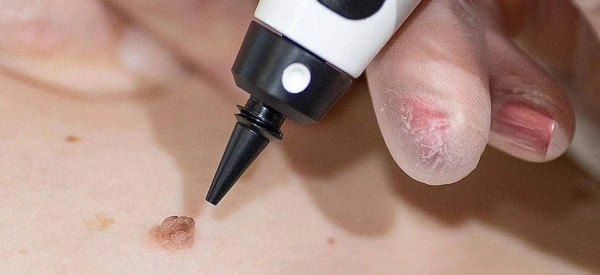 skin tag removal using cryopen Birmingham