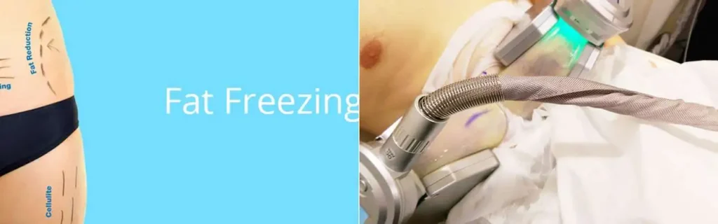 multi areas of a persons body having coolsculpting Birmingham treatment