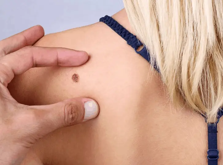 woman having mole removal Birmingham consultation before treatment.