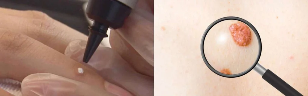 Person getting moles removed with cryopen Birmingham