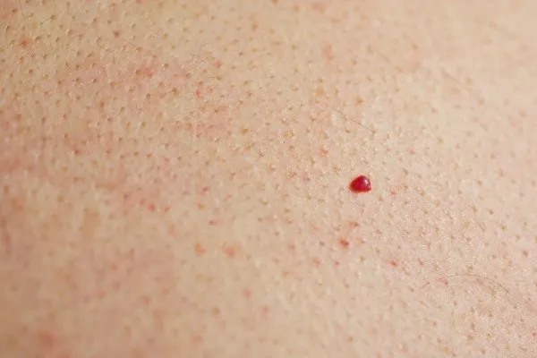 close up of a cherry angioma Birmingham