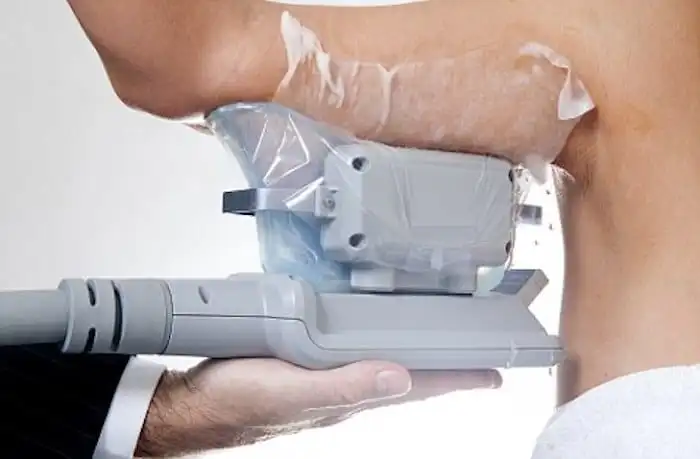 Picture of fat freezing Birmingham on the upper arms.