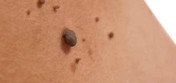 image of a skin tag Birmingham