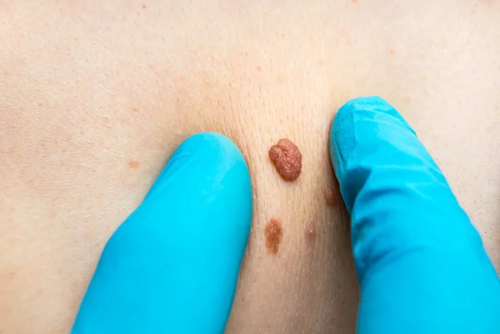 Consultant examining a skin tag Birmingham