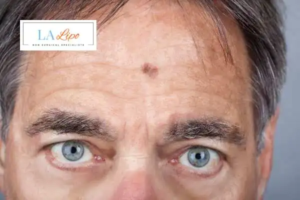 Solar Lentigo Removal Birmingham image of man with mark on his forehead