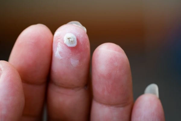 wart on person finger - cryotherapy to treat from LA LIPO Birmingham