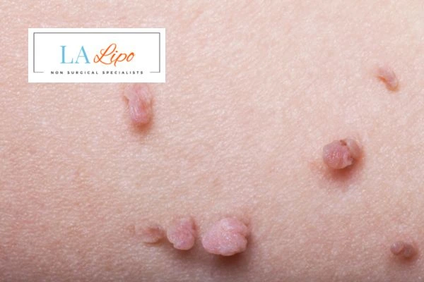 Does cryopen skin tag removal Birmingham hurt? Find out now call our team today!