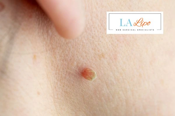 Book skin tag removal Birmingham today speak to our team now!