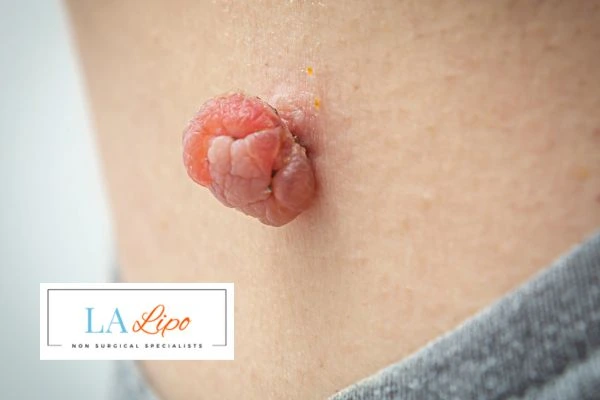 Interested in skin tag removal Birmingham? Concerned about the pain? Find out more today!