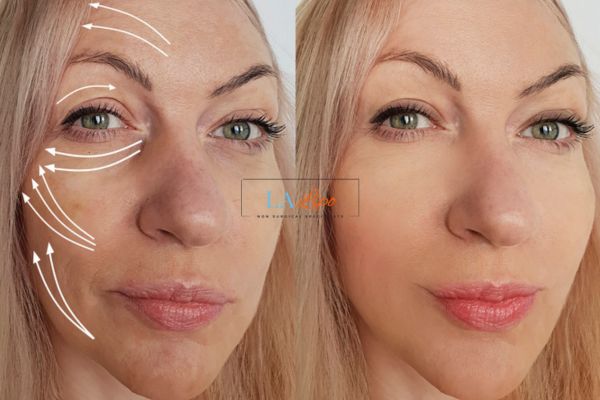 Morpheus 8 results Birmingham face lift.