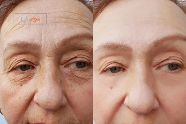 The powerful benefits of Morpheus8 Treatment Birmingham - Call Our team today!