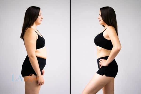 Picture of womans before and after using LA-EMS body sculpting to improve her core strength Birmingham
