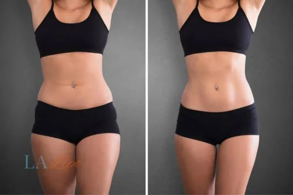 before and after results of non-surgical treatment to help a woman's body image and mental health Birmingham