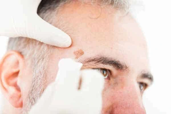Age spots and elderly people Birmingham what is the link?