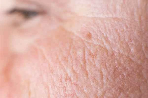 close up picture of a woman's face showing an age spot Birmingham