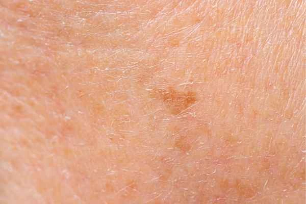 close up picture of age spots Birmingham