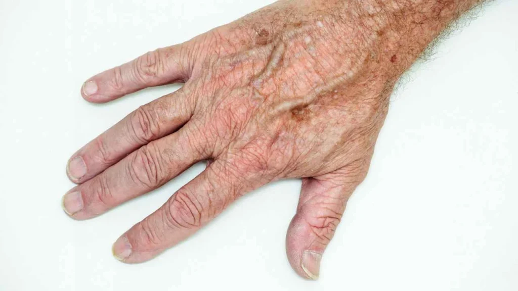 Male hand showing age spot Birmingham