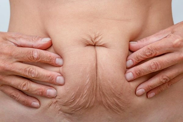 Image of a woman's stomach with loose skin - example of skin tightening Birmingham options