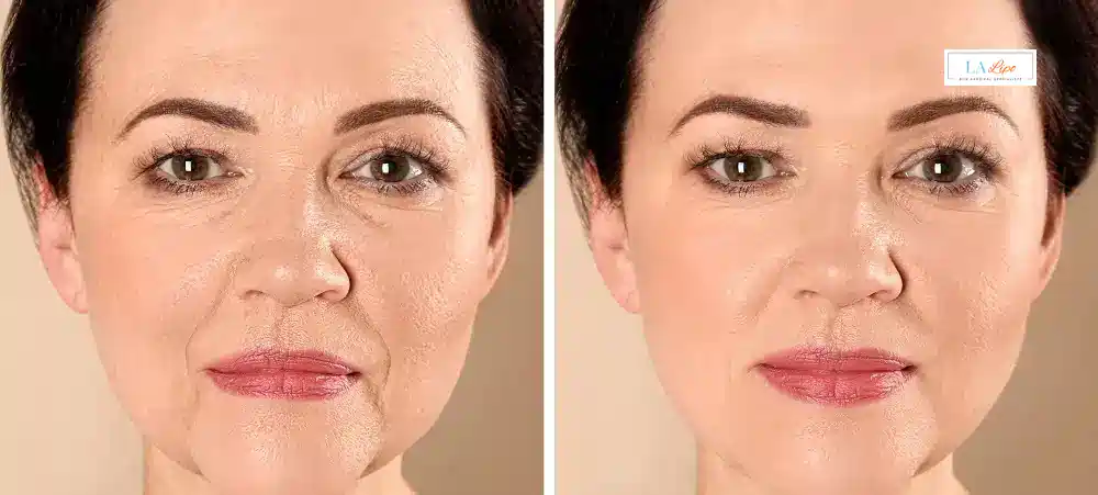 How Long Does It Take to See Results and How Long Do They Last Birmingham?