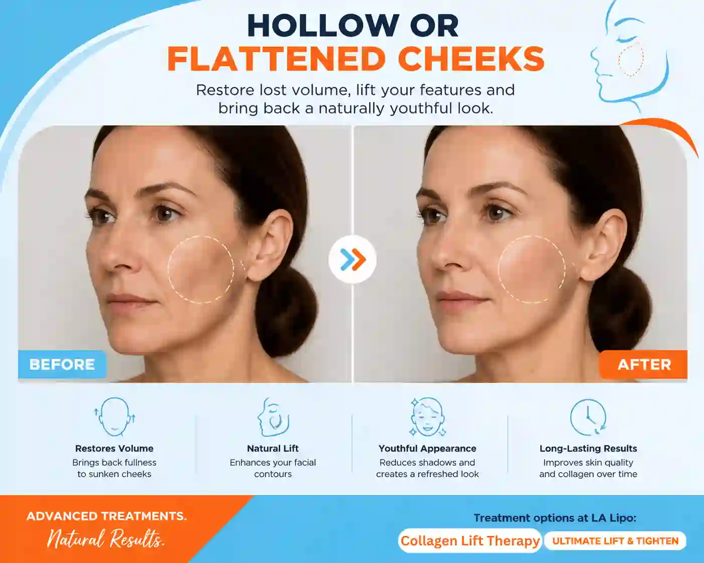 Sign #4: Hollow or Flattened Cheeks Birmingham