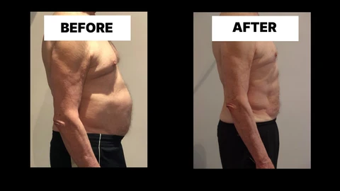 What Symptoms Can Diastasis Recti Cause in Men? Weak Core, Back Pain and Poor Posture Birmingham